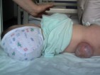Hydrocephalus und/oder Spina Bifida Kinder in Rumänien